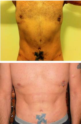 abetching Abdominal Etching Before and After Pictures