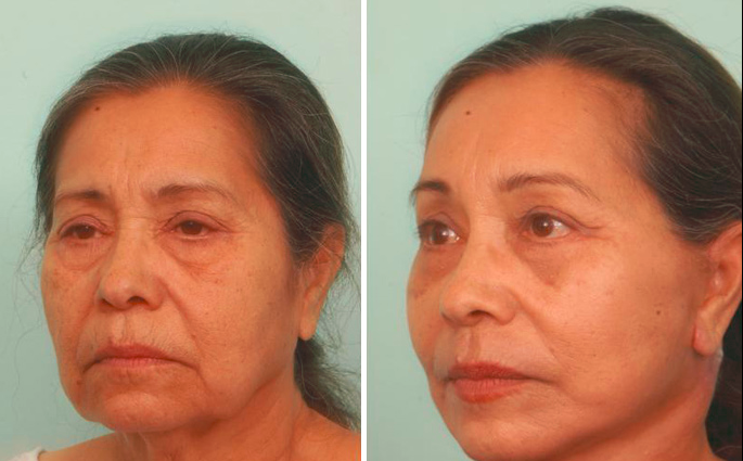 Facelifts: Are You Ready for a Change but Want Results that Look ...