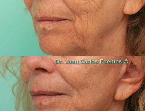The fountain of youth: a Facelift at COSMED