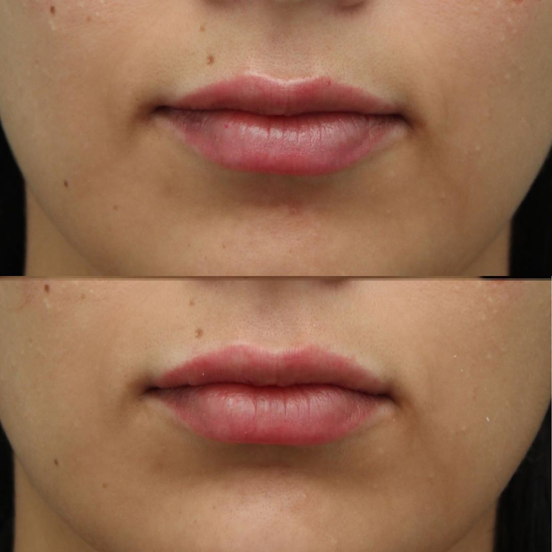 fillers, non-surgical treatment, botox, juvederm, beauty